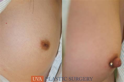 Inverted Nipple Correction Before And After Pictures Case 7
