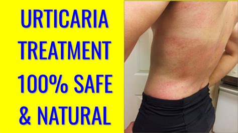 Urticaria Treatment Best Treatment For Urticaria How To Cure