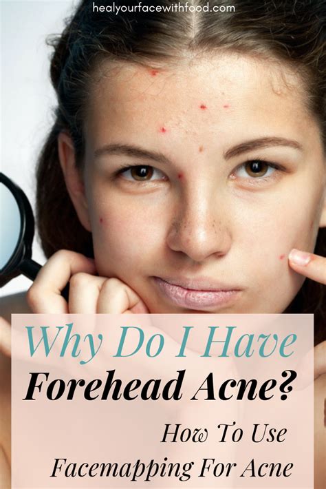 Forehead Acne Why Do I Have Acne On My Forehead Heal Your Face With