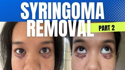 Syringoma Removal Part 2 Price Clinic Etc Youtube