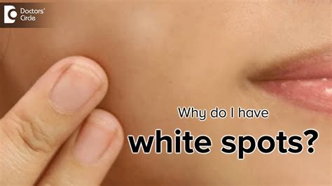 What Does Light Spots On Your Skin Mean