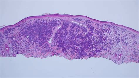 Merkel Cell Carcinoma 101 Primary Cutaneous Neuroendocrine Carcinoma