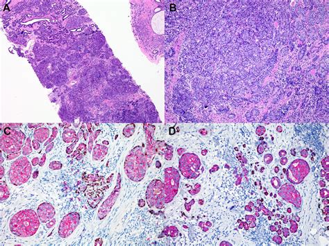 Breast Carcinoma In Sclerosing Adenosis A Clinicopathological And
