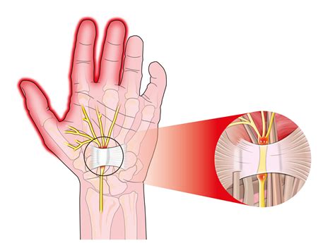 Carpal Tunnel Syndrome The Pain Relief Clinic