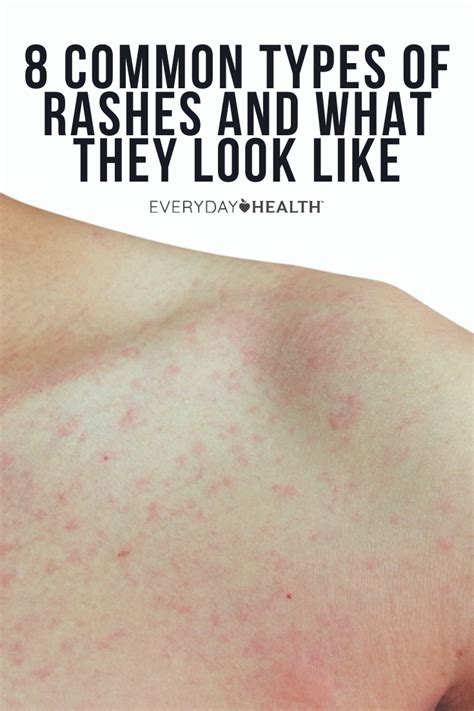 8 Common Types Of Rashes And What They Look Like Types Of Rashes Itching Rash Rashes