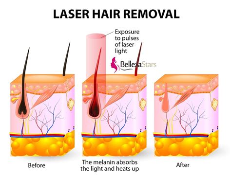A diode laser offers an effective treatment while protecting the skin during the hair removal process. Permanent Hair Removal Diode Laser Depilation Machine ...