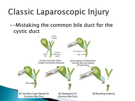 Ppt Biliary Injuries During Laparoscopic Cholecystectomy Powerpoint