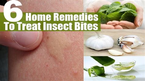 How To Get Rid Of A Mosquito Bite With Home Remedies Youtube