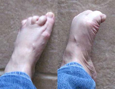 Hammer Toe Surgery Procedure Sonja Canedo
