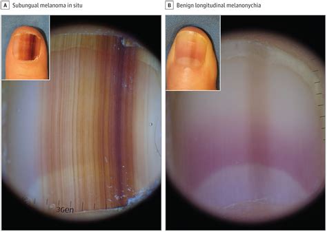 It may occur on any fingernail or toenail, with a greater incidence on the great toe and thumb. Assessment of a Predictive Scoring Model for Dermoscopy of ...