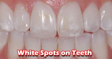 White Spots On Teeth Best Oral Hygiene
