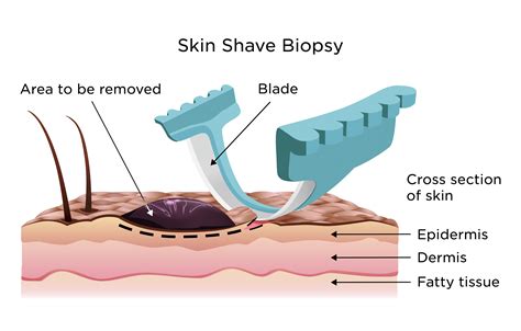 Skin Biopsy My Doctor Online