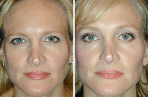 Better Than Botox Tri Aktiline The Temporary Instant Deep Wrinkle
