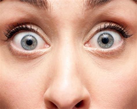 Bulging Eyes Causesexercises And Safety Tips