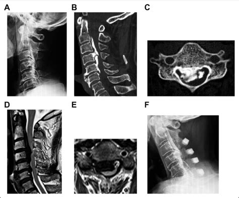 A Year Old Man With Cervical Ossification Of The Posterior