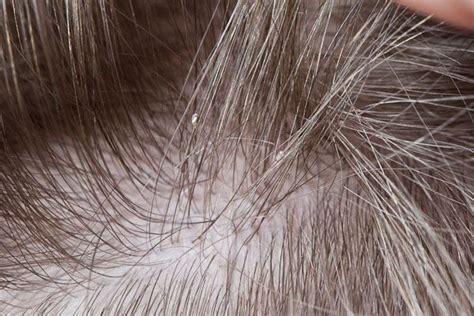 Close Up Of Head Lice Egg About Nits Lice Eggs Pinterest Lice