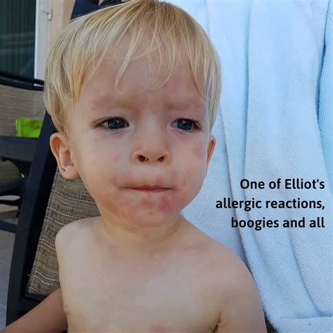 Allergy Testing 2 Year Olds Drbrowns
