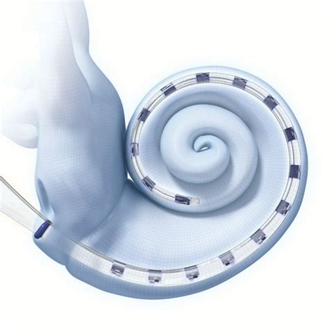 Internal Components Of A Cochlear Implant Advanced Bionics