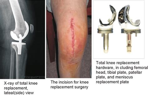 Surgical Procedure Of Total Knee Replacement Download Scientific Diagram