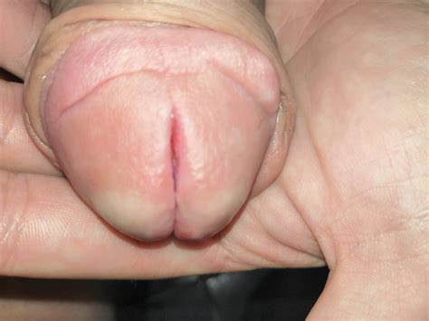 Split Penis Pics XHamster