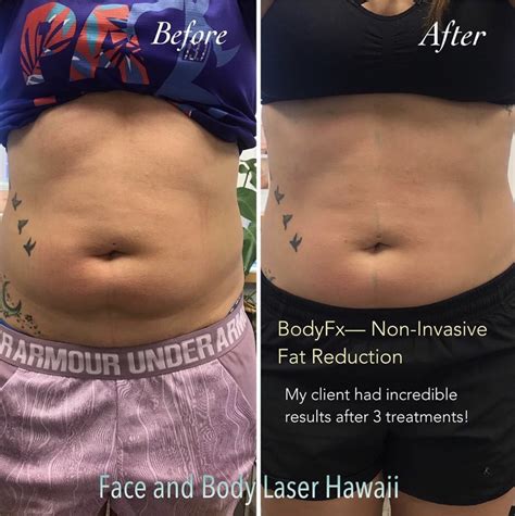 Laser Liposuction Treatment In Hawaii Dullophob