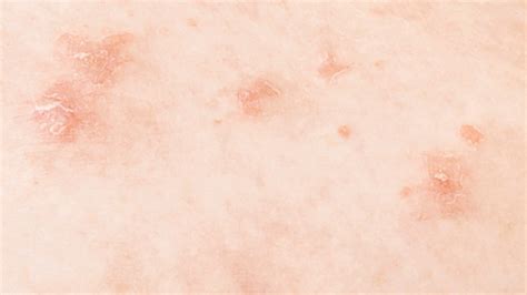 Learn about different causes of lung cancer including tobacco smoking. Sarcoidosis: Causes, Symptoms, and Treatment
