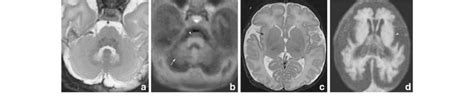 Neuroimaging A Neurologically Normal Neonate T2 Weighted Mri Axial