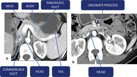 Imaging Of The Pancreas Radiology Key