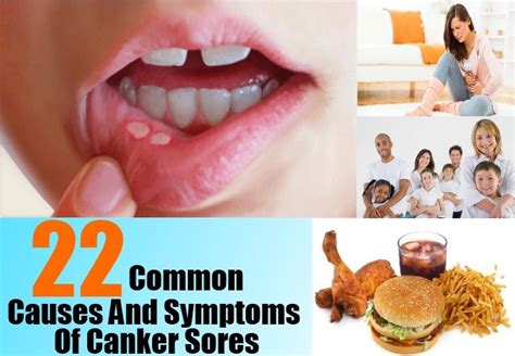 22 Common Causes And Symptoms Of Canker Sores Canker Sore Causes