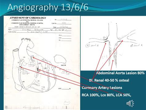 Triple Vessel Coronary Artery Disease Youtube