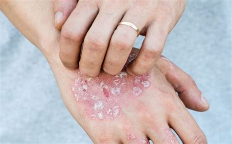 Plaques Flat And Raised Skin Changes In Plaque Psoriasis