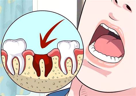 CirugÍa Bucal ¿qué Es Una Alveolitis Dental Por Qué Se Presenta Y