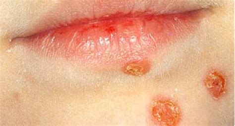 Impetigo How To Protect Your Kids From The Contagious Skin Infection
