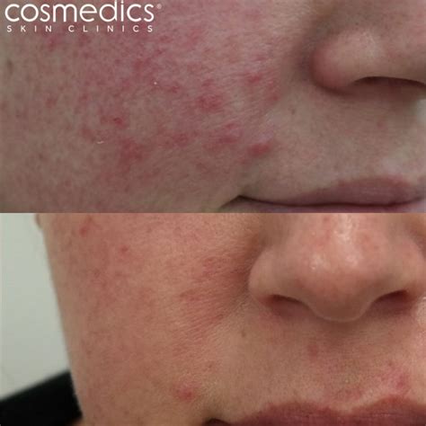 Sinewi Weide Gereiztheit Rosacea Laser Treatment Before And After