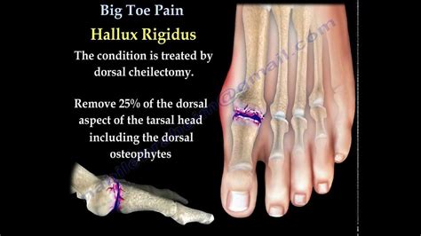 Injured Big Toe Joint