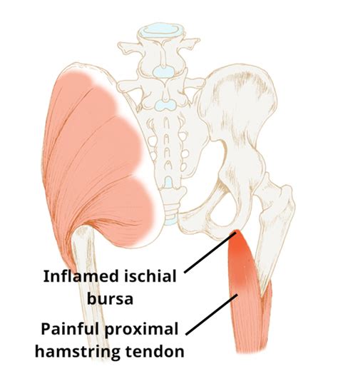 Ischial Sitting Bone Bursitis Pain Circle Integrated Care