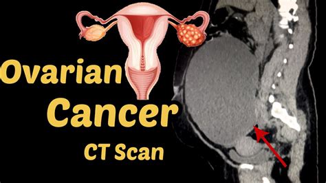 Ovarian Cancer Diagnosis Ct Scan Radiology Youtube
