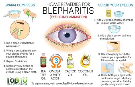Home Remedies For Blepharitis Eyelid Inflammation Top 10 Home Remedies