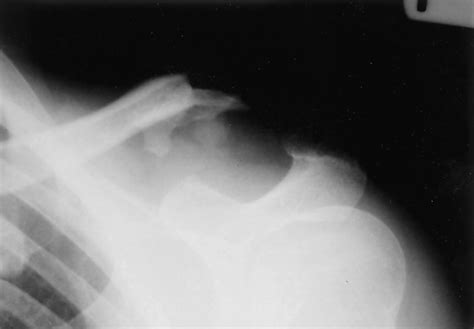 Failure Of Acromioclavicular Reconstruction Using Gore Tex Graft Due To