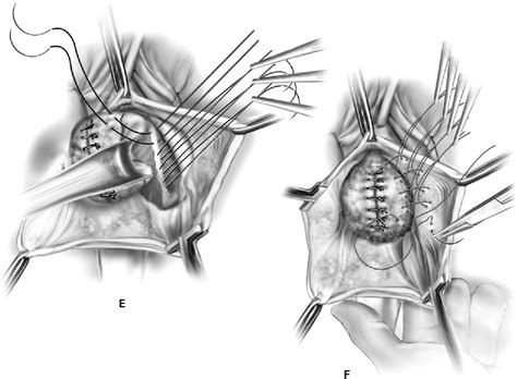 Anatomic And Functional Outcome Of Vaginal Paravaginal Repair In The