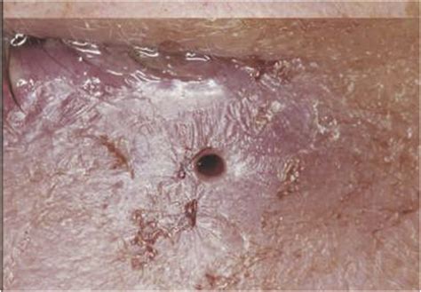 Cutaneous Myiasis—a Stowaway From Central America Clinical
