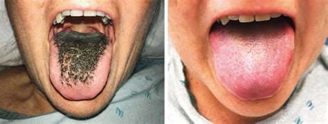 What Is Black Hairy Tongue It Looks Gross But The Oral Condition Is