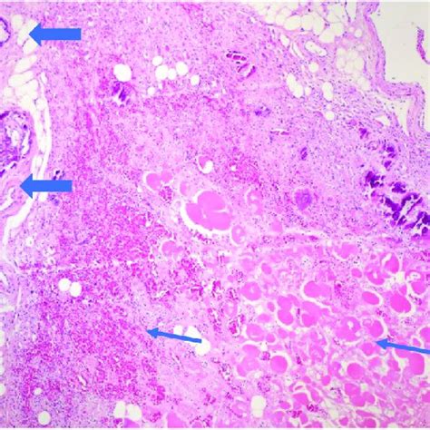 Necrotic Skin Lesions Demonstrating Black Eschar On The Right Lower Leg