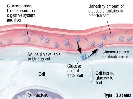 Type 1 Diabetes Mellitus Guide: Causes, Symptoms and Treatment Options