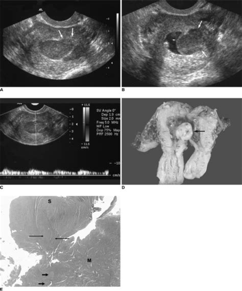Figure 2sonographic Findings Of Uterine Endometrial Stromal Sarcoma