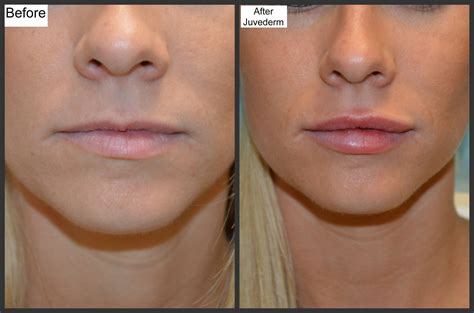 Before and After Photos- Millefiori | Dermal fillers, Restylane lips