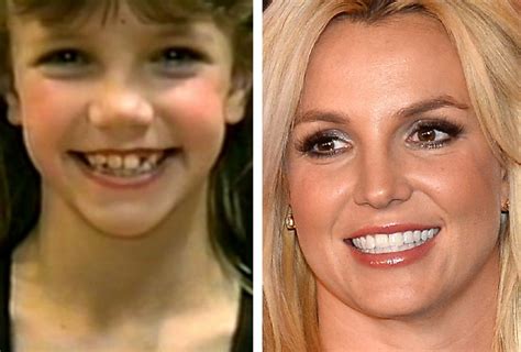 Britney Spears Before And After Cosmetic Surgery Verge Campus