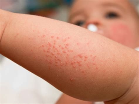 Common Skin Problems In Newborns Healthy Living