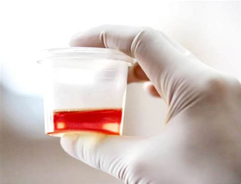 9 Reasons Blood Is In Your Urine Daily Trust