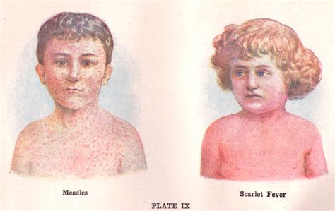 Scarlet Fever A Deadly History And How It Prevails